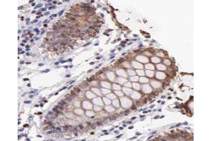 ABIN6266556 at 1/100 staining human colon carcinoma tissue sections by IHC-P. (HSPA9 抗体)