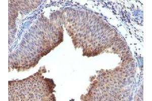 IHC testing of FFPE human bladder carcinoma and Cytokeratin 6 antibody. (Keratin 6 抗体  (C-Term))