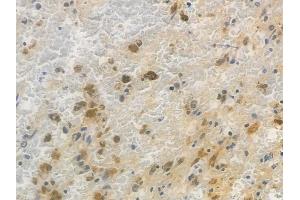 ABIN7094703 and ABIN7098754 at 1/100 staining human melanoma by IHC-P.
