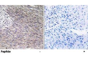 Immunohistochemistry analysis of paraffin-embedded human cervix carcinoma tissue using CHPF polyclonal antibody . (CHPF 抗体)