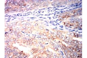 Immunohistochemical analysis of paraffin-embedded cervical cancer tissues using CD267 mouse mAb with DAB staining.