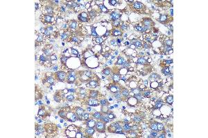 Immunohistochemistry of paraffin-embedded Human liver cancer using TIMMDC1 Rabbit pAb (ABIN7270929) at dilution of 1:100 (40x lens). (TIMMDC1 抗体  (AA 206-285))