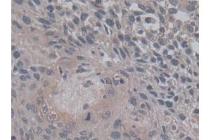 IHC-P analysis of Human Lung cancer Tissue, with DAB staining. (TGFB3 抗体  (AA 24-300))