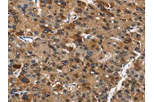 The image on the left is immunohistochemistry of paraffin-embedded Human liver cancer tissue using ABIN7190434(DCC Antibody) at dilution 1/70, on the right is treated with synthetic peptide. (DCC 抗体)