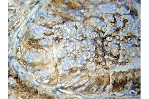 Immunohistochemistry of paraffin-embedded Breast cancer using STAT5B Antibody. (STAT5B 抗体  (AA 40-280))