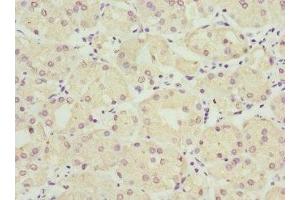 Immunohistochemistry of paraffin-embedded human gastric cancer using ABIN7149954 at dilution of 1:100 (FMO1 抗体  (AA 363-532))