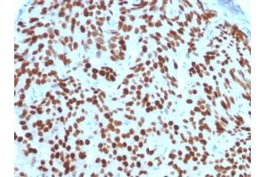 Formalin-fixed, paraffin-embedded human Prostate Carcinoma stained with NKX3.