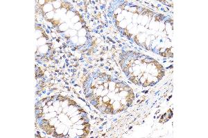 Immunohistochemistry of paraffin-embedded Human colon using MMP17 Rabbit pAb (ABIN3017219, ABIN3017220, ABIN3017221 and ABIN1680859) at dilution of 1:100 (40x lens). (MMP17 抗体)