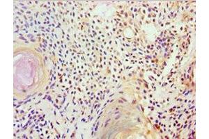 Immunohistochemistry of paraffin-embedded human breast cancer using ABIN7152570 at dilution of 1:100 (FUBP3 抗体  (AA 65-260))