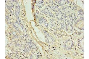 Immunohistochemistry of paraffin-embedded human breast cancer using ABIN7145079 at dilution of 1:100 (Aurora Kinase B 抗体  (AA 1-255))