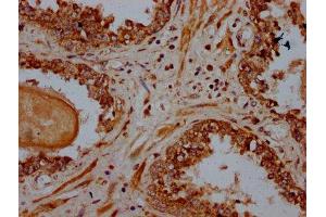 IHC image of ABIN7164923 diluted at 1:600 and staining in paraffin-embedded human prostate cancer performed on a Leica BondTM system.