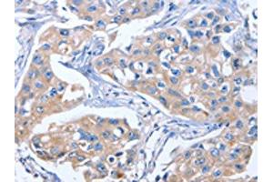 The image on the left is immunohistochemistry of paraffin-embedded Human breast cancer tissue using ABIN7191031(IBSP Antibody) at dilution 1/50, on the right is treated with synthetic peptide. (IBSP 抗体)