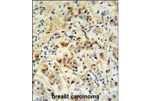 mouse BID Antibody (S61)IHC analysis in formalin fixed and paraffin embedded human breast carcinoma followed by peroxidase conjugation of the secondary antibody and DAB staining. (BID 抗体  (AA 39-68))