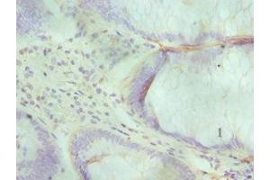 Immunohistochemistry of paraffin-embedded human colon cancer using ABIN7143716 at dilution of 1:100 (ALKBH1 抗体  (AA 110-389))