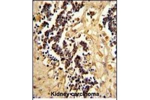 Formalin-fixed and paraffin-embedded human kidney carcinoma reacted with EHD3 Antibody (Center), which was peroxidase-conjugated to the secondary antibody, followed by DAB staining. (EHD3 抗体  (AA 189-216))