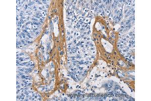 Immunohistochemistry of Human cervical cancer using COL3A1 Polyclonal Antibody at dilution of 1:60 (COL3A1 抗体)