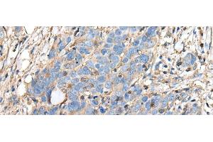 Immunohistochemistry of paraffin-embedded Human thyroid cancer tissue using PLA2G16 Polyclonal Antibody at dilution of 1:40(x200) (PLA2G16 抗体)