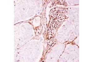 Immunohistochemical staining (Formalin-fixed paraffin-embedded sections) of human lung cancer tissue with ABCB1 polyclonal antibody  under 0. (ABCB1 抗体  (AA 621-650))