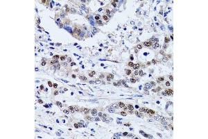 Immunohistochemistry of paraffin-embedded human colon carcinoma using UHRF1 antibody. (UHRF1 抗体  (AA 1-260))