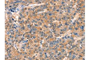 The image on the left is immunohistochemistry of paraffin-embedded Human liver cancer tissue using ABIN7189890(ARHGAP4 Antibody) at dilution 1/25, on the right is treated with synthetic peptide. (ARHGAP4 抗体)