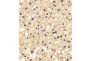 (ABIN6242522 and ABIN6577190) staining PGK1 in human liver tissue sections by Immunohistochemistry (IHC-P - paraformaldehyde-fixed, paraffin-embedded sections). (PGK1 抗体  (AA 1-417))