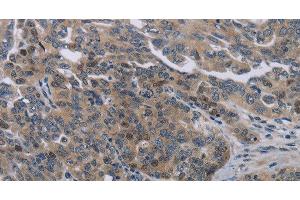 Immunohistochemistry of paraffin-embedded Human ovarian cancer tissue using NOX1 Polyclonal Antibody at dilution 1:50 (NOX1 抗体)