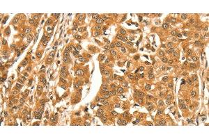 Immunohistochemistry of paraffin-embedded Human breast cancer tissue using DIRAS1 Polyclonal Antibody at dilution 1:52 (DIRAS1 抗体)