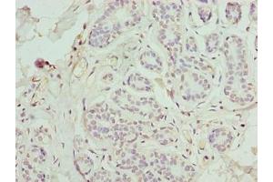 Immunohistochemistry of paraffin-embedded human breast cancer using ABIN7165550 at dilution of 1:100 (FAM71F1 抗体  (AA 121-343))