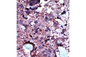 Formalin-fixed and paraffin-embedded human cancer tissue reacted with the primary antibody, which was peroxidase-conjugated to the secondary antibody, followed by AEC staining. (PKLR 抗体  (N-Term))