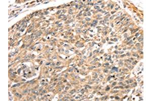 The image on the left is immunohistochemistry of paraffin-embedded Human lung cancer tissue using ABIN7191289(LONP1 Antibody) at dilution 1/25, on the right is treated with synthetic peptide. (LONP1 抗体)