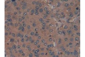 Detection of RI in Human Liver cancer Tissue using Polyclonal Antibody to Ribonuclease Inhibitor (RI) (RNH1 抗体  (AA 218-444))