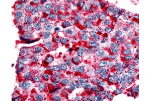 Anti-NPBWR2 / GPR8 antibody IHC of human Lung, Non-Small Cell Carcinoma.