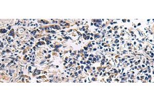Immunohistochemistry of paraffin-embedded Human breast cancer tissue using DRGX Polyclonal Antibody at dilution of 1:45(x200) (DRGX 抗体)