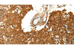 Immunohistochemistry of paraffin-embedded Human breast cancer using SKP1 Polyclonal Antibody at dilution of 1:30 (SKP1 抗体)