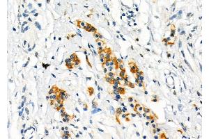 ABIN6262693 and ABIN6273257 at 1/100 staining Human pancreatic cancer by IHC-P.
