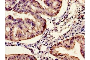 Immunohistochemistry of paraffin-embedded human endometrial cancer using ABIN7161170 at dilution of 1:100 (SYNE2 抗体  (AA 1-176))