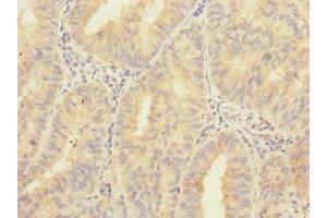 Immunohistochemistry of paraffin-embedded human endometrial cancer using ABIN7176401 at dilution of 1:100 (ZNF582 抗体  (AA 1-300))