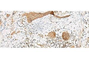 Immunohistochemistry of paraffin-embedded Human esophagus cancer tissue using GSTM2 Polyclonal Antibody at dilution of 1:50(x200) (GSTM2 抗体)