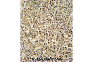 RNT2 antibody (N-term) immunohistochemistry analysis in formalin fixed and paraffin embedded human spleen carcinoma followed by peroxidase conjugation of the secondary antibody and DAB staining. (RNASET2 抗体  (N-Term))