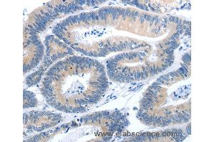 Immunohistochemistry of Human colon cancer using GNAZ Polyclonal Antibody at dilution of 1:25 (GNaZ 抗体)