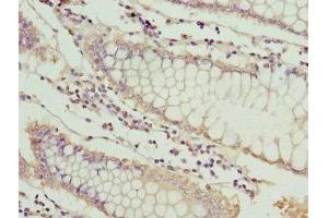 Immunohistochemistry of paraffin-embedded human colon cancer using ABIN7159525 at dilution of 1: 100 (MT1G 抗体  (AA 1-59))