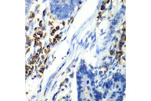 Immunohistochemistry of paraffin-embedded human colon carcinoma using ASGR1 antibody. (Asialoglycoprotein Receptor 1 抗体)