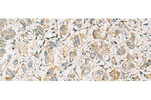 Immunohistochemistry of paraffin-embedded Human liver cancer tissue using PDE4DIP Polyclonal Antibody at dilution of 1:60(x200) (PDE4DIP 抗体)