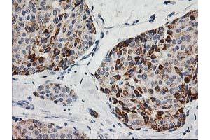 Immunohistochemical staining of paraffin-embedded Adenocarcinoma of Human breast tissue using anti-AK4 mouse monoclonal antibody. (AK4 抗体)