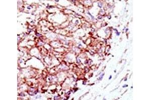 IHC analysis of FFPE human hepatocarcinoma tissue stained with the Mib1 antibody (MIB1 抗体  (AA 13-42))