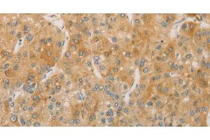 Immunohistochemistry of paraffin-embedded Human liver cancer using ACSL4 Polyclonal Antibody at dilution of 1:60 (ACSL4 抗体)