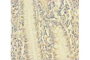 Immunohistochemistry of paraffin-embedded human colon cancer using ABIN7175481 at dilution of 1:100 (VAMP5 抗体  (AA 1-72))