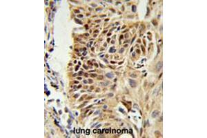 CIRBP Antibody (C-term) IHC analysis in formalin fixed and paraffin embedded human lung carcinoma followed by peroxidase conjugation of the secondary antibody and DAB staining. (CIRBP 抗体  (C-Term))