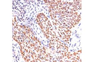 IHC staining of lung squamous cell carcinoma with p40 antibody. (p40 (p63 Delta) (AA 5-17) 抗体)