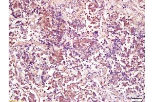 Formalin-fixed and paraffin embedded human lung carcinoma labeled with Anti-PP2A alpha + beta Polyclonal Antibody, Unconjugated (ABIN723875) at 1:200 followed by conjugation to the secondary antibody and DAB staining (PP2A alpha/beta 抗体  (AA 205-309))